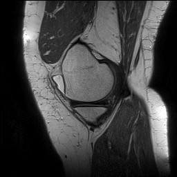 Acute-on-chronic transient lateral patellar dislocation with trochlear dysplasia (Radiopaedia 84099-99349 Sagittal PD 42).jpg