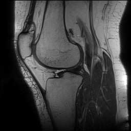 File:Acute-on-chronic transient lateral patellar dislocation with trochlear dysplasia (Radiopaedia 84099-99349 Sagittal PD 97).jpg