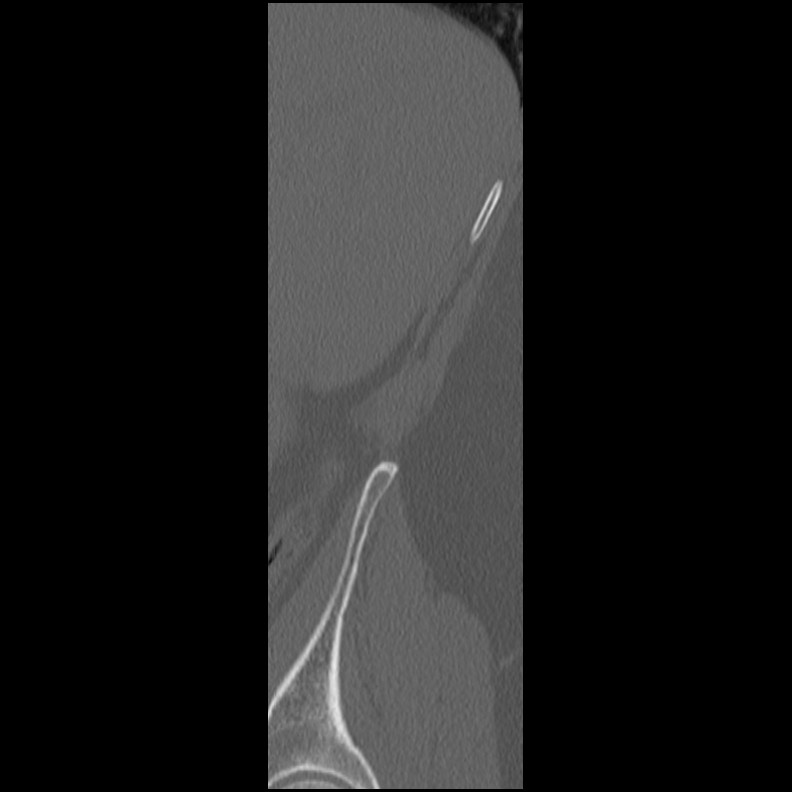 Acute Schmorl's node (Radiopaedia 83276-102365 Sagittal bone window 86).jpg