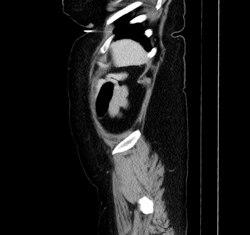 Acute appendicitis, heterotaxy syndrome (Radiopaedia 66884-76202 Sagittal C+ portal venous phase 114).jpg