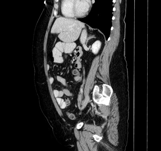 Acute appendicitis, heterotaxy syndrome (Radiopaedia 66884-76202 Sagittal C+ portal venous phase 84).jpg