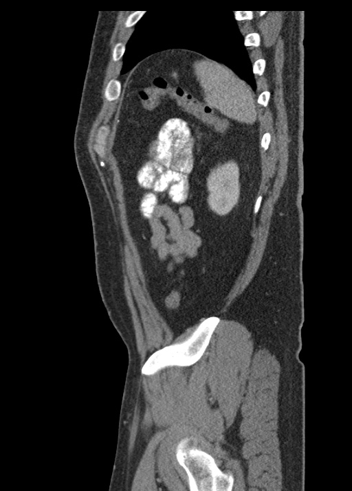 Acute appendicitis (Radiopaedia 48511-53463 Sagittal C+ portal venous phase 109).jpg