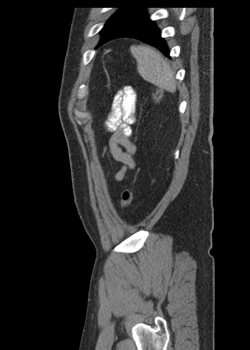 Acute appendicitis (Radiopaedia 48511-53463 Sagittal C+ portal venous phase 113).jpg