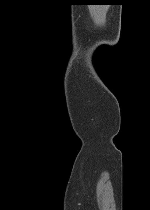 Acute appendicitis (Radiopaedia 48511-53463 Sagittal C+ portal venous phase 132).jpg