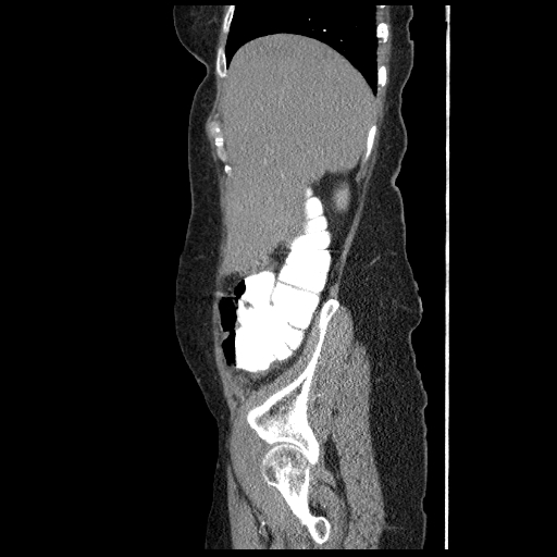 File:Acute appendicitis (Radiopaedia 52672-58589 Sagittal C+ arterial phase 18).jpg