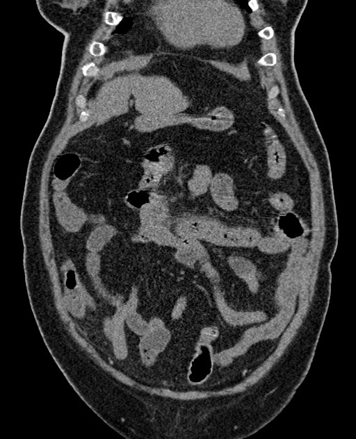 Acute appendicitis (Radiopaedia 58627-65818 Coronal non-contrast 28).jpg