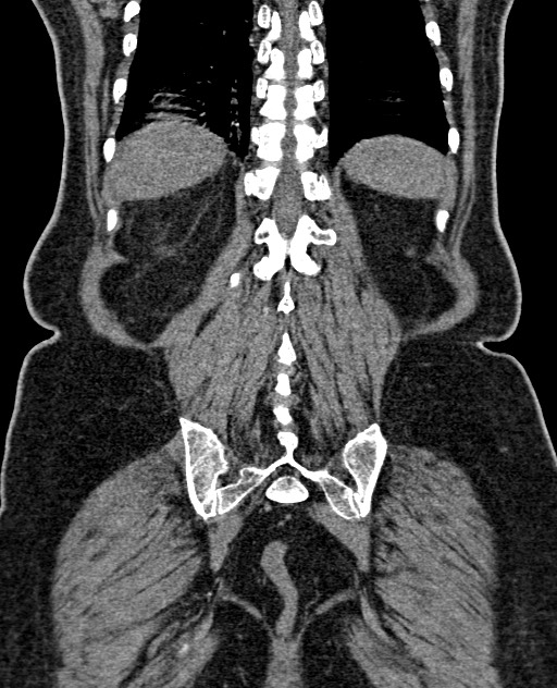Acute appendicitis (Radiopaedia 58627-65818 Coronal non-contrast 55).jpg