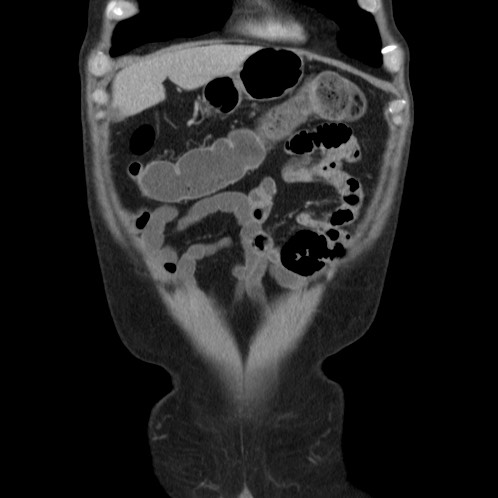 Acute appendicitis (Radiopaedia 66513-75790 Coronal C+ portal venous phase 3).jpg