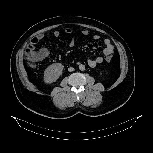 Acute appendicitis (Radiopaedia 79950-93224 Axial non-contrast 53).jpg