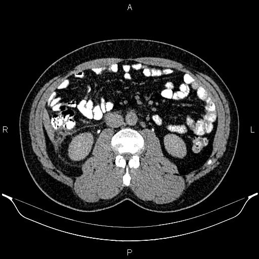 File:Acute appendicitis (Radiopaedia 84780-100240 Axial C+ delayed 50).jpg
