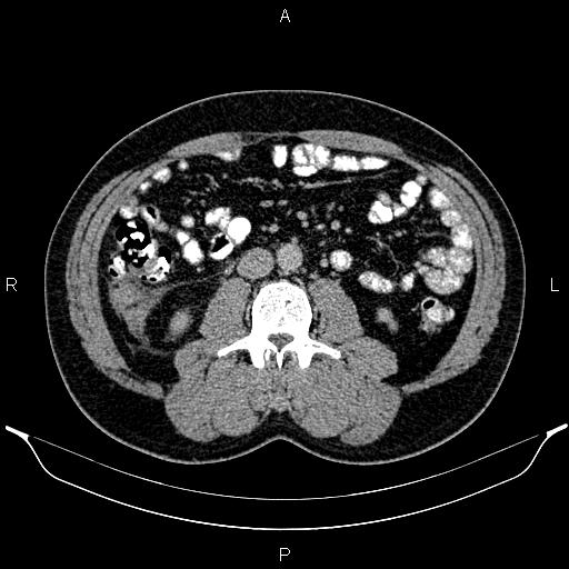 Acute appendicitis (Radiopaedia 84780-100240 Axial C+ portal venous phase 54).jpg