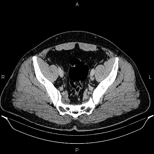 Acute appendicitis (Radiopaedia 84780-100240 Axial C+ portal venous phase 91).jpg