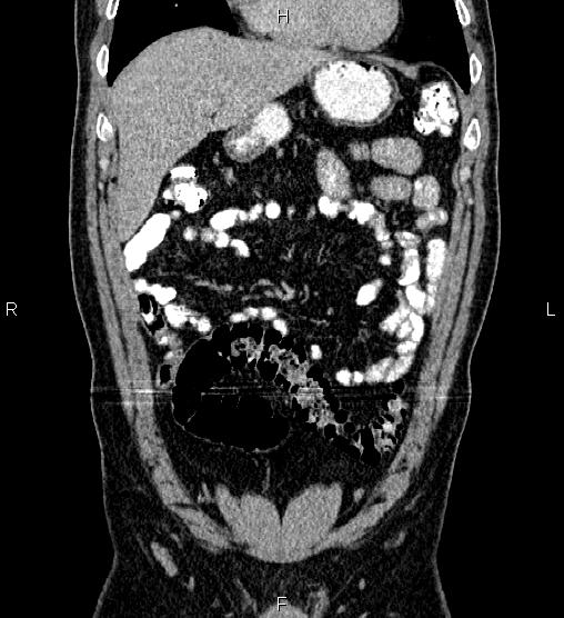 Acute appendicitis (Radiopaedia 84780-100240 Coronal C+ portal venous phase 21).jpg
