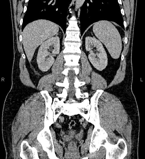 Acute appendicitis (Radiopaedia 84780-100240 Coronal C+ portal venous phase 58).jpg