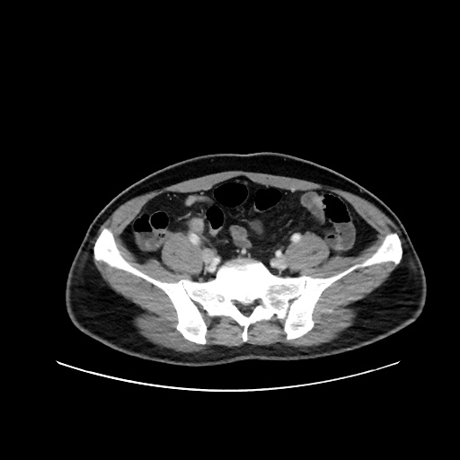 File:Acute appendicitis and COVID 19 pneumonia (Radiopaedia 76604-88380 Axial C+ portal venous phase 62).jpg