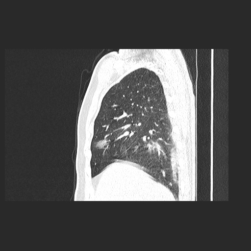 Acute appendicitis and COVID 19 pneumonia (Radiopaedia 76604-88380 Sagittal lung window 27).jpg
