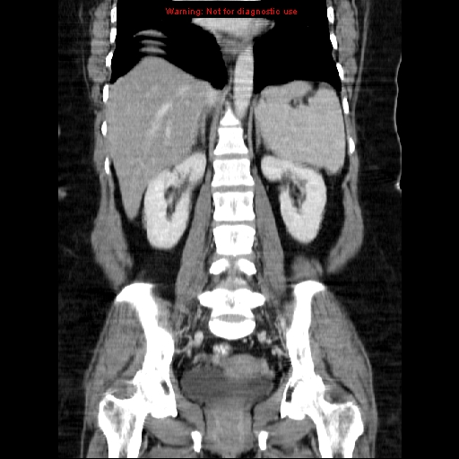 Acute appendicitis complicated by ovarian vein thrombophlebitis (Radiopaedia 16172-15851 Coronal C+ portal venous phase 53).jpg