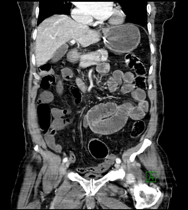 Acute arterial mesenteric ischemia (Radiopaedia 78238-90828 Coronal C+ portal venous phase 43).jpg