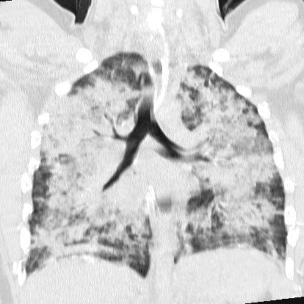 Acute aspiration pneumonitis (Radiopaedia 33605-34703 Coronal lung window 48).jpg