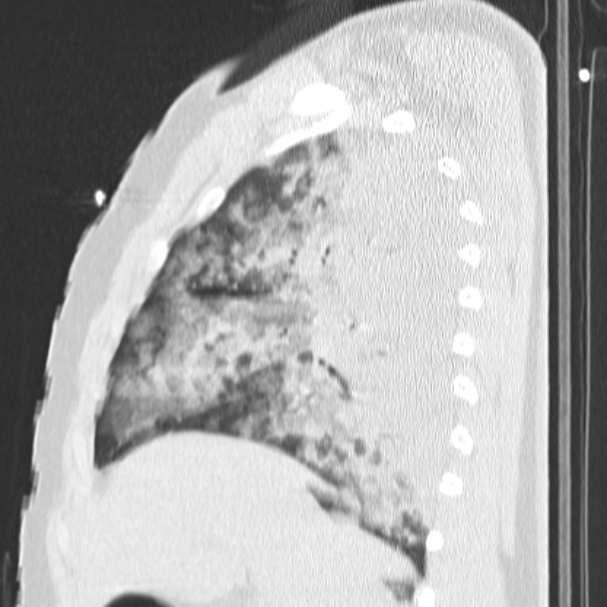 Acute aspiration pneumonitis (Radiopaedia 33605-34703 Sagittal lung window 31).jpg