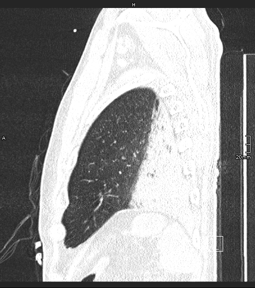 Acute aspiration pneumonitis (Radiopaedia 55642-62166 Sagittal lung window 14).jpg