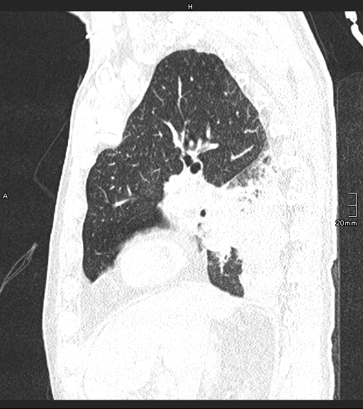 Acute aspiration pneumonitis (Radiopaedia 55642-62166 Sagittal lung window 98).jpg
