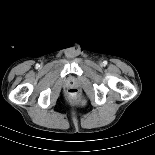 Acute bowel ischemia (Radiopaedia 87695-104114 Axial C+ portal venous phase 87).jpg