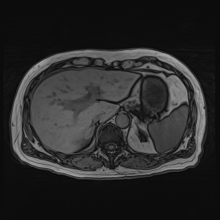 Acute cholecystitis (Radiopaedia 72392-82923 Axial T1 out-of-phase 38).jpg