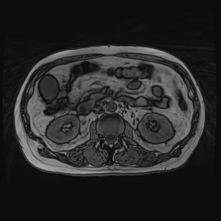 Acute cholecystitis (Radiopaedia 72392-82923 Axial T1 out-of-phase 68).jpg