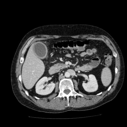 Acute cholecystitis and incidental left sided IVC (Radiopaedia 49352-54459 Axial C+ portal venous phase 64).jpg