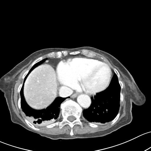 Acute cholecystitis with contained perforation (Radiopaedia 47328-51907 Axial C+ portal venous phase 7).png