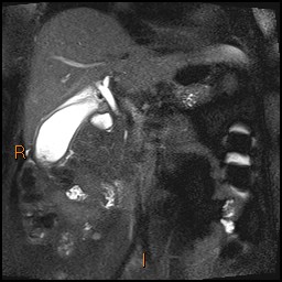 File:Acute cholecystitis with gallbladder neck calculus (Radiopaedia 42795-45971 Coronal T2 Half-fourier-acquired single-shot turbo spin echo (HASTE) 6).jpg