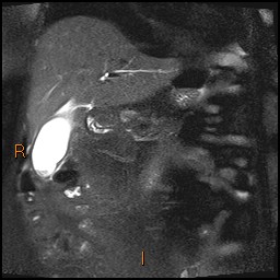 File:Acute cholecystitis with gallbladder neck calculus (Radiopaedia 42795-45971 Coronal T2 Half-fourier-acquired single-shot turbo spin echo (HASTE) 9).jpg