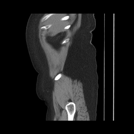 Acute cholecystitis with tensile fundus sign (Radiopaedia 71394-81723 Sagittal non-contrast 37).jpg