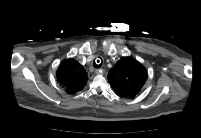 Acute cor pulmonale (ultrasound) (Radiopaedia 83508-98818 Axial C+ CTPA 7).jpg