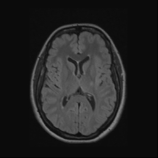 Acute disseminated encephalomyelitis (ADEM) (Radiopaedia 38073-40065 Axial FLAIR 34).png