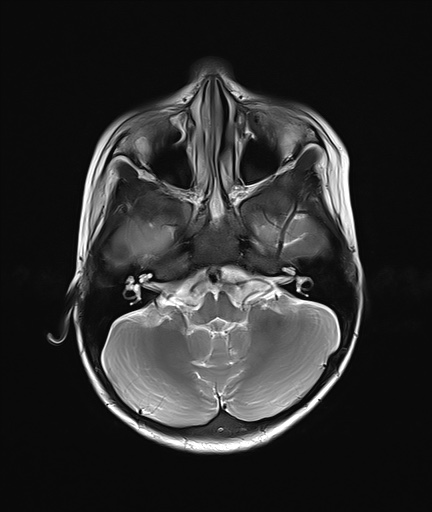 File:Acute disseminating encephalomyelitis with bilateral optic neuritis (Radiopaedia 79676-92886 Axial T2 6).jpg
