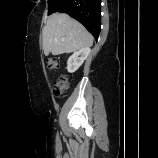 Acute diverticulitis - transverse colon (Radiopaedia 87063-103327 Sagittal C+ portal venous phase 83).jpg