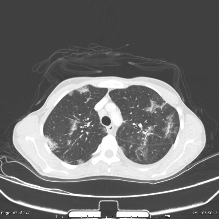 Acute eosinophilic pneumonia (Radiopaedia 48211-53073 Axial lung window 24).jpg