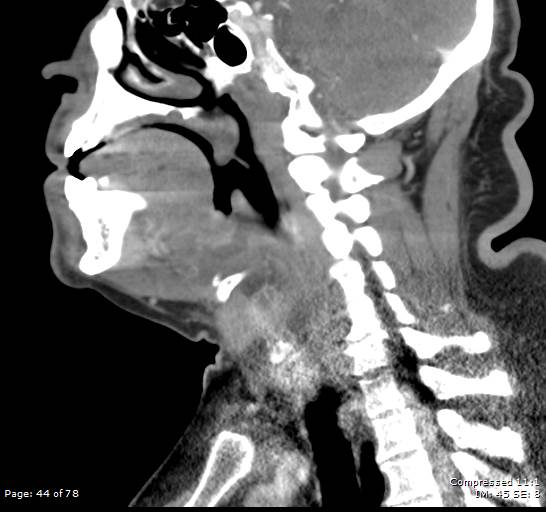 Acute epiglottitis (Radiopaedia 54375-60590 Sagittal C+ arterial phase 44).jpg