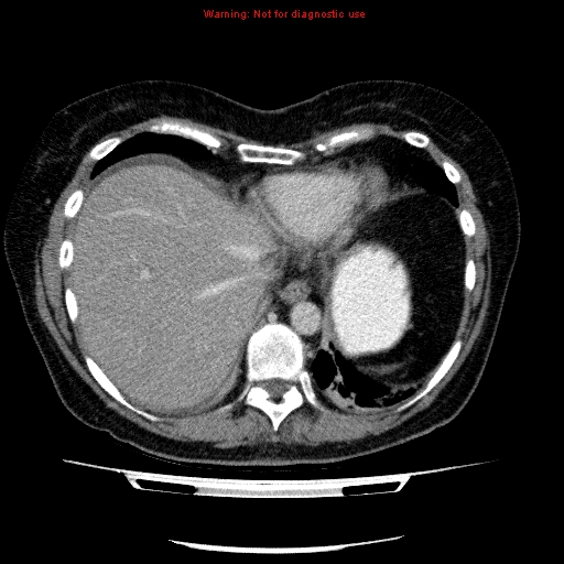Acute gangrenous cholecystitis (Radiopaedia 10123-10661 Axial C+ portal venous phase 13).jpg