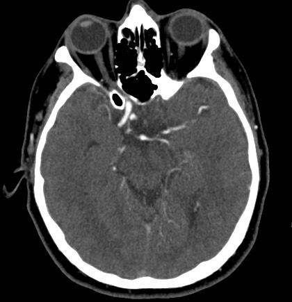 File:Acute internal carotid artery dissection (Radiopaedia 53541-59630 Axial C+ arterial phase 26).jpg