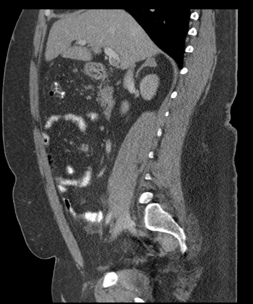 Acute mesenteric venous ischemia (Radiopaedia 46041-50383 Sagittal C+ portal venous phase 46).jpg