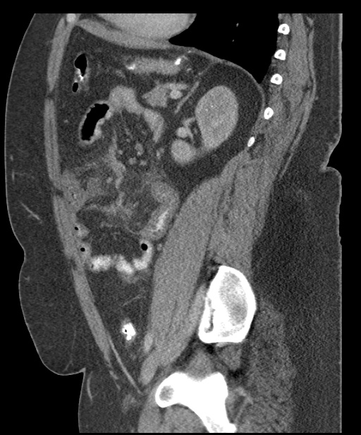 Acute mesenteric venous ischemia (Radiopaedia 46041-50383 Sagittal C+ portal venous phase 76).jpg