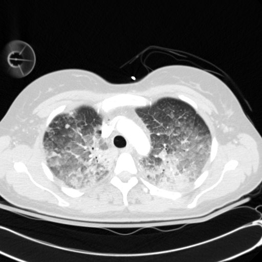 Acute myocardial infarction in CT (Radiopaedia 39947-42415 Axial lung window 31).jpg