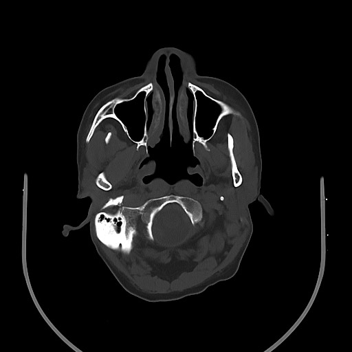 Acute on chronic subdural hematoma (Radiopaedia 74814-85823 D 26).jpg