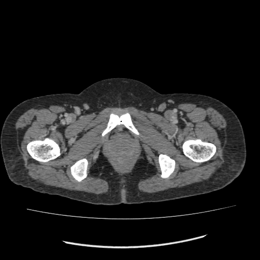 Acute pancreatitis (Radiopaedia 80007-93285 Axial C+ portal venous phase 124).jpg