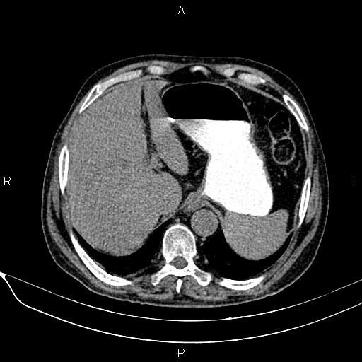 Acute pancreatitis (Radiopaedia 85146-100701 Axial non-contrast 26).jpg
