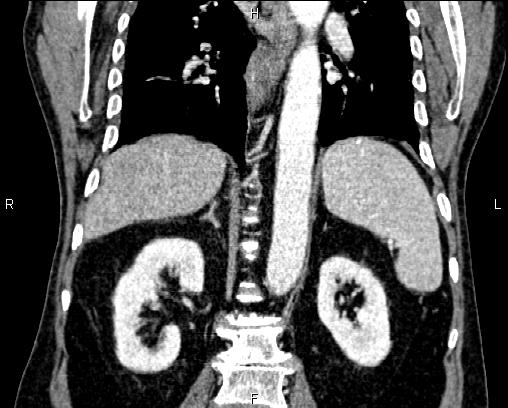 Acute pancreatitis (Radiopaedia 85146-100701 Coronal C+ portal venous phase 51).jpg