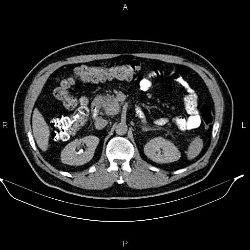 File:Acute pancreatitis (Radiopaedia 85390-101010 Axial C+ delayed 29).jpg